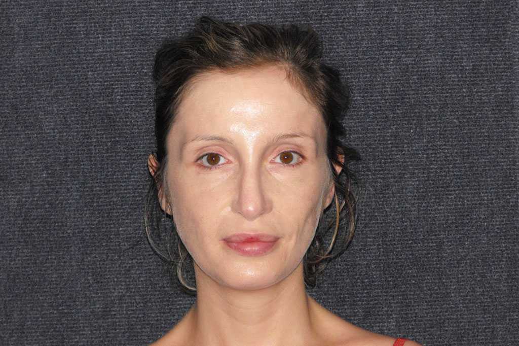 Nose Correction CLOSED TIP RHINOPLASTY ante/post-op I