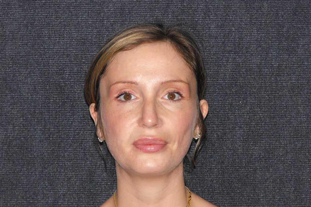 Nasenkorrektur RHINOPLASTIK ante/post-op I