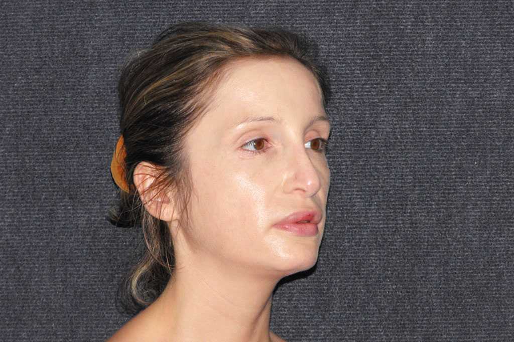 Nose Correction CLOSED TIP RHINOPLASTY ante/post-op II