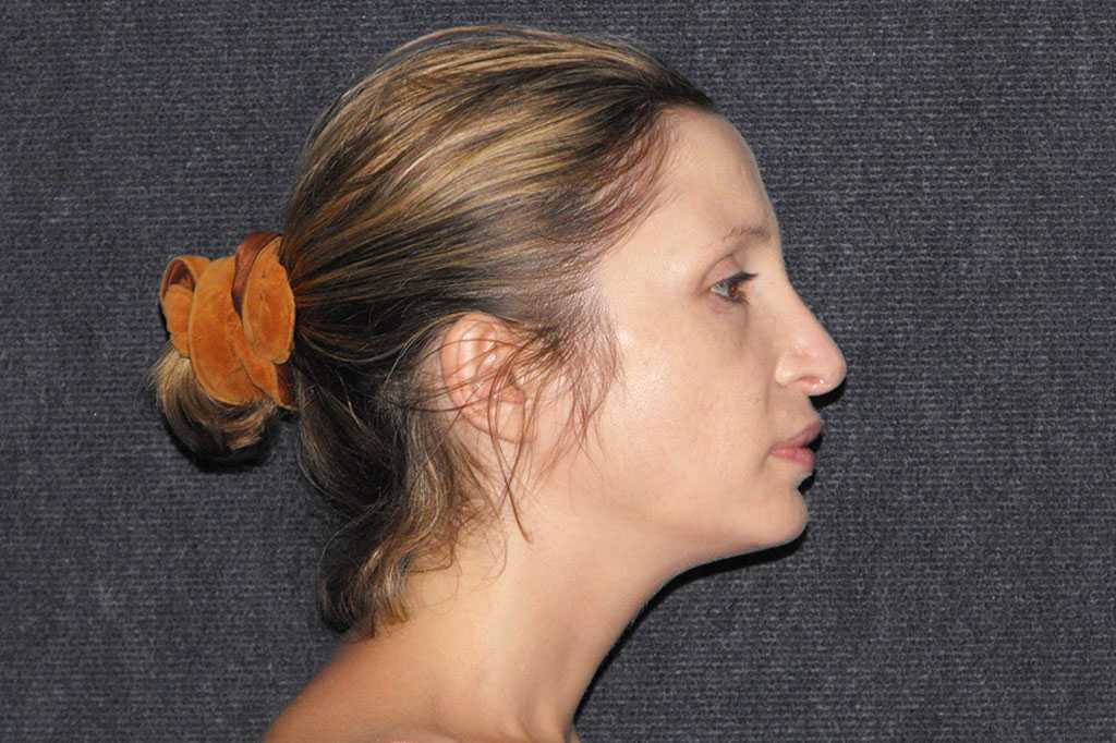 Nasenkorrektur RHINOPLASTIK ante/post-op III