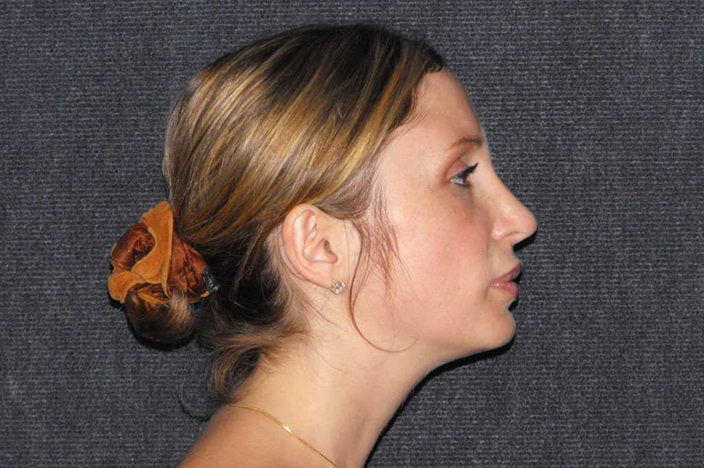 Nasenkorrektur RHINOPLASTIK ante/post-op III