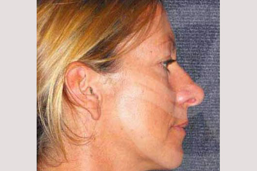 Cirugía de la nariz RINOPLASTIA CERRADA ante/post-op III