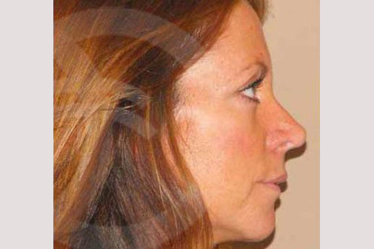 Cirugía de la nariz RINOPLASTIA CERRADA ante/post-op III