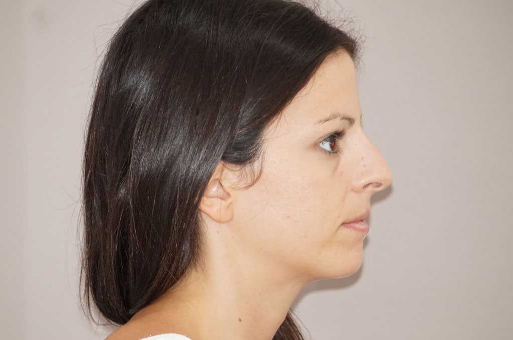 Chirurgie du nez 1 ante-op lateral