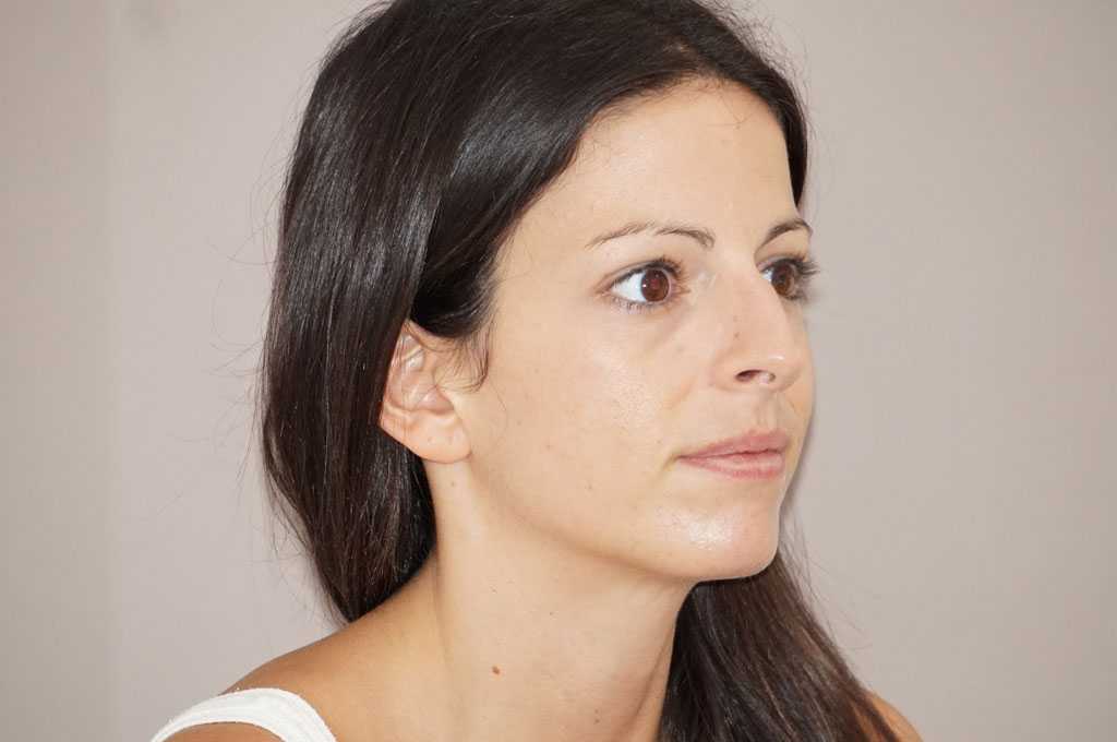 Cirugía de la nariz RINOPLASTIA ante-op retro/lateral