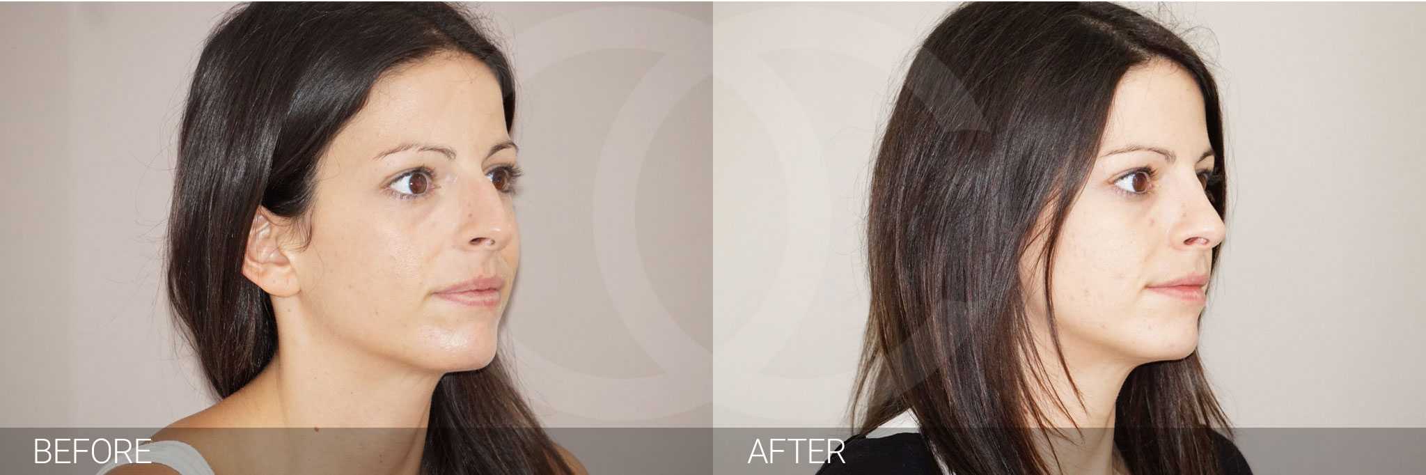 Closed Rhinoplasty, nose job photo befor and after side