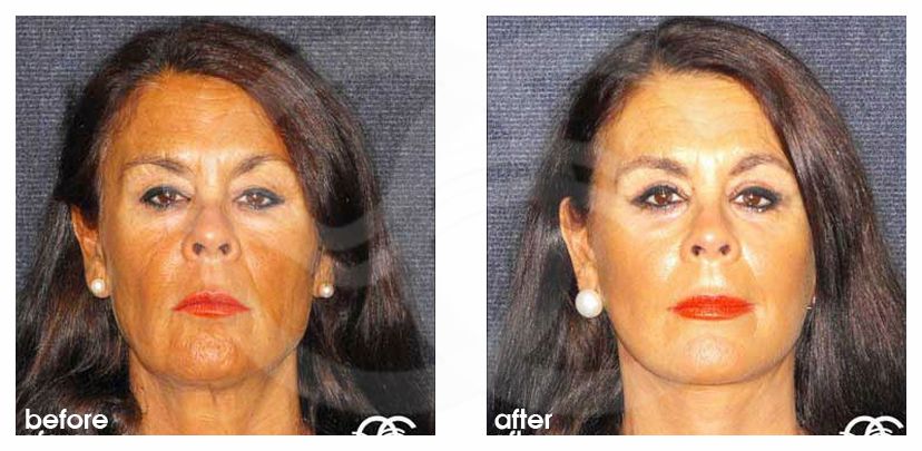 Industry Leading Facelift surgery before and after real clinical case 03