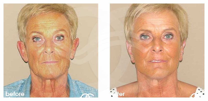 Industry Leading Facelift surgery before and after real clinical case 02