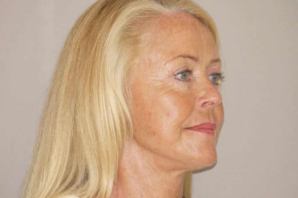 Result after face & necklift – 3/4 view