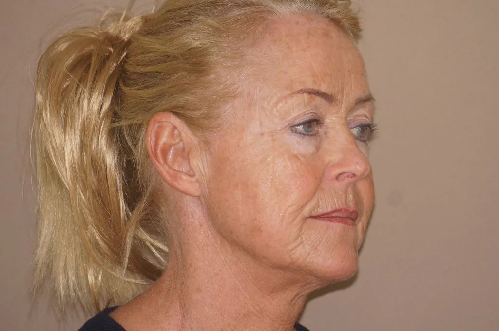 Face & Necklift before surgery – 3/4 view
