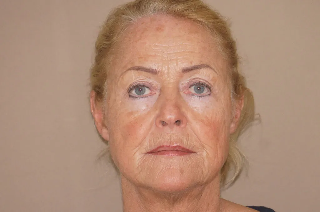 Face & Necklift in Marbella before surgery – front view
