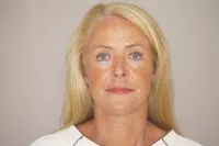 Real case of face & necklift in Marbella - 01