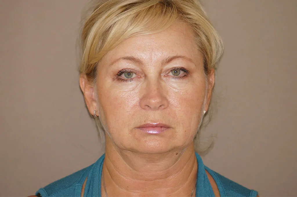 Face & Necklift in Marbella before surgery – front view