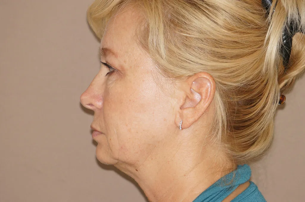 Face & Necklift before surgery – side view