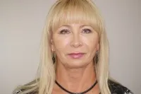 Real case of face & necklift in Marbella - 02