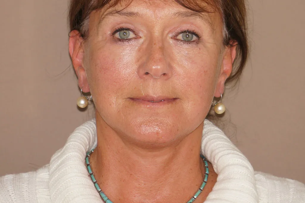 Result after face & necklift – front view