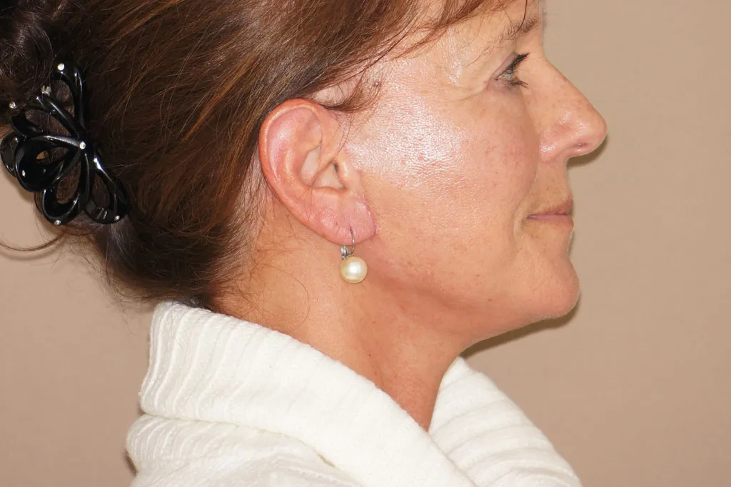 Result after face & necklift – side view