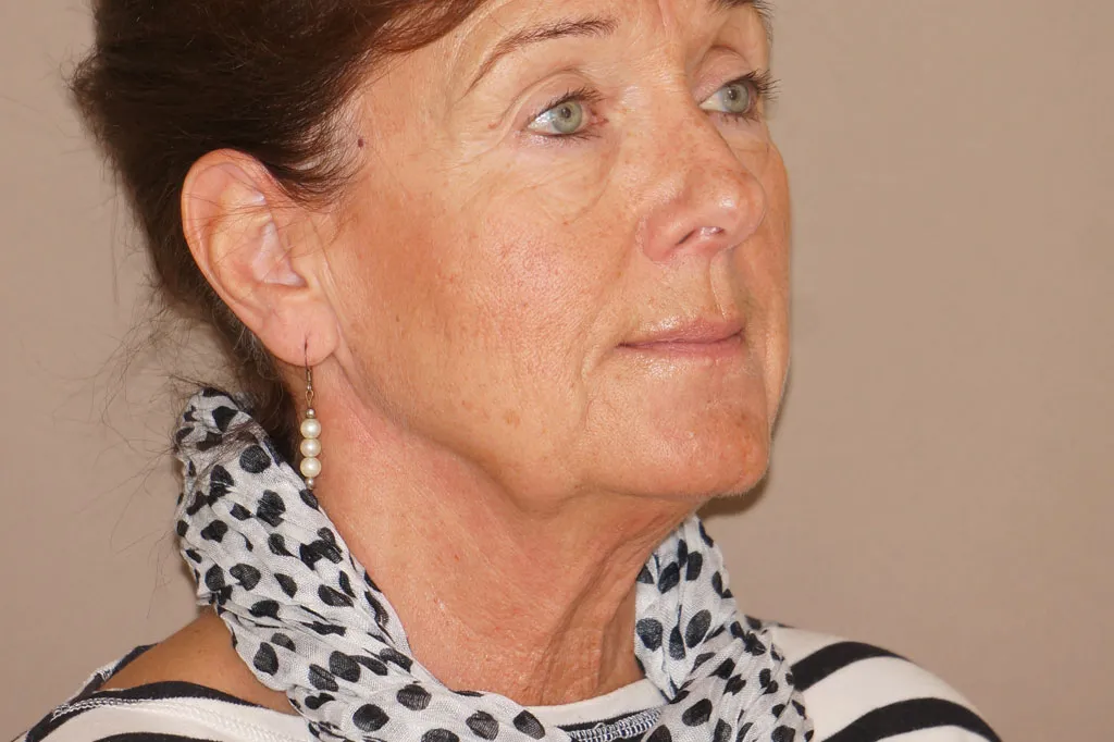 Face & Necklift before surgery – 3/4 view