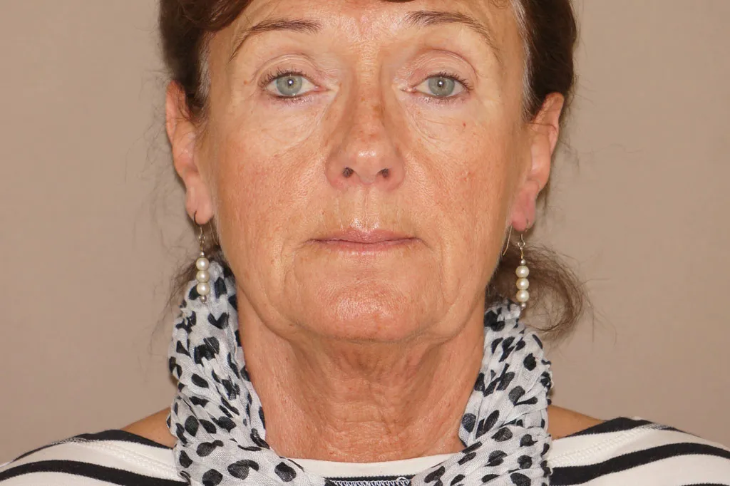Face & Necklift in Marbella before surgery – front view