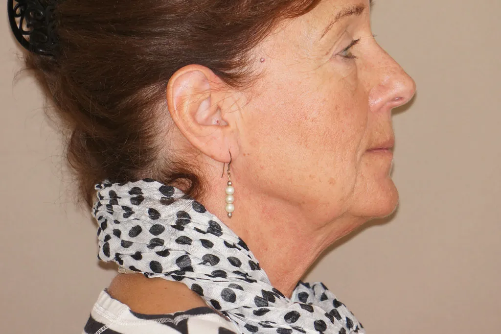 Face & Necklift before surgery – side view