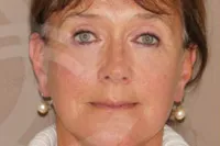 Real case of face & necklift in Marbella - 03