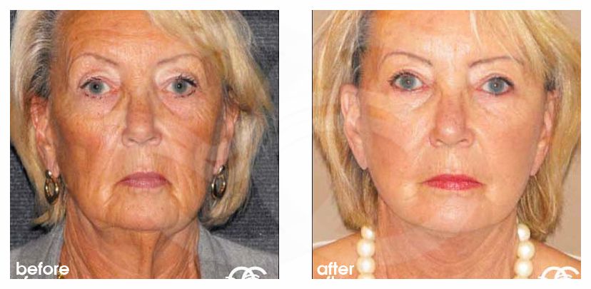 Injerto de grasa facial Lipofilling ante/post-op profil