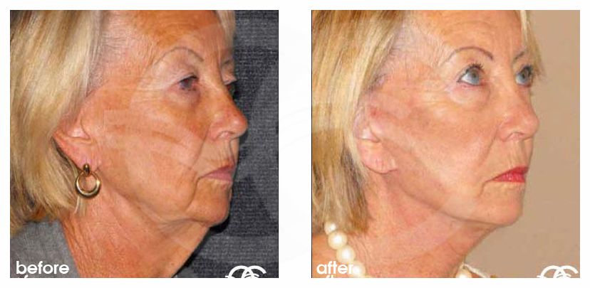 Injerto de grasa facial Lipofilling ante/post-op lateral