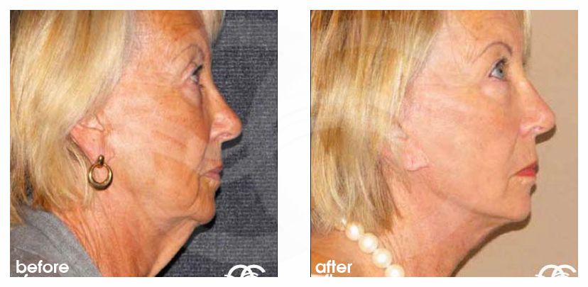 Injerto de grasa facial Lipofilling ante/post-op retro/lateral