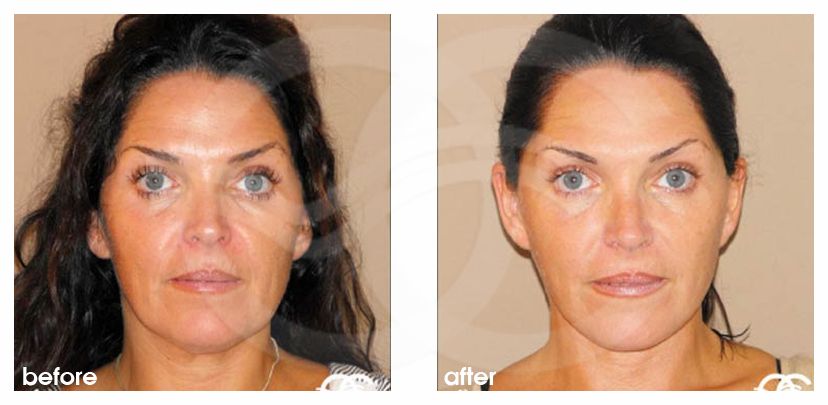 Lipofilling du visage 03 ante/post-op profil