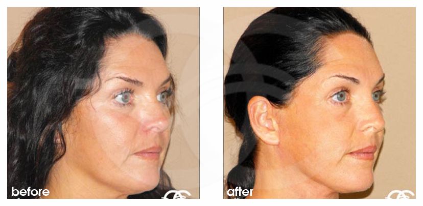 Lipofilling du visage 03 ante/post-op lateral