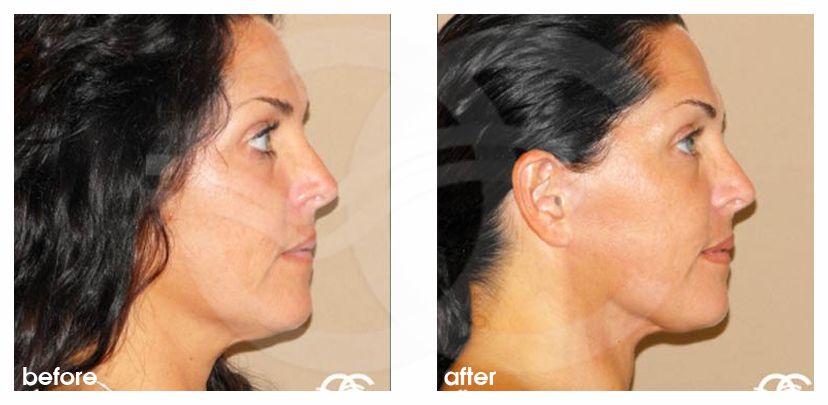 Lipofilling du visage 03 ante/post-op retro/lateral