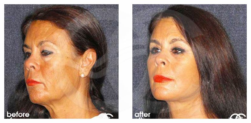 Face and Neck Lift MACS lift ante/post-op lateral