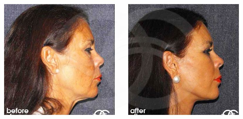 Face and Neck Lift MACS lift ante/post-op retro/lateral