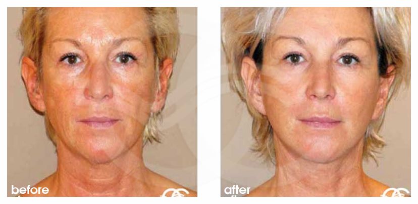 Gesichts und Halsstraffung 11 FACELIFTING BILDER LIPOFILLING MIT EIGENFETT before after forntal