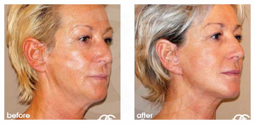 Gesichts und Halsstraffung 11 FACELIFTING BILDER LIPOFILLING MIT EIGENFETT before after side