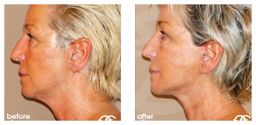 Gesichts und Halsstraffung 11 FACELIFTING BILDER LIPOFILLING MIT EIGENFETT before after perfil