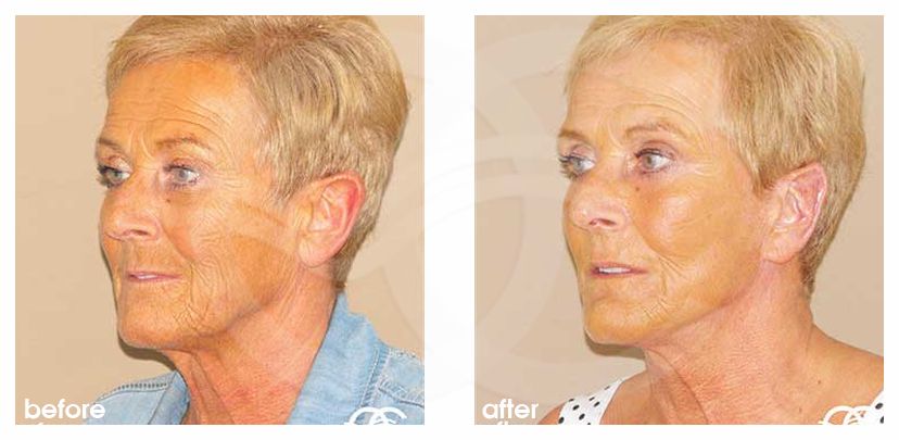 Lifting de cara y cuello PAVE cara y cuello ante/post-op lateral