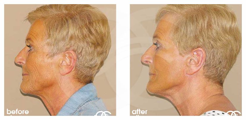 Lifting de cara y cuello PAVE cara y cuello ante/post-op retro/lateral