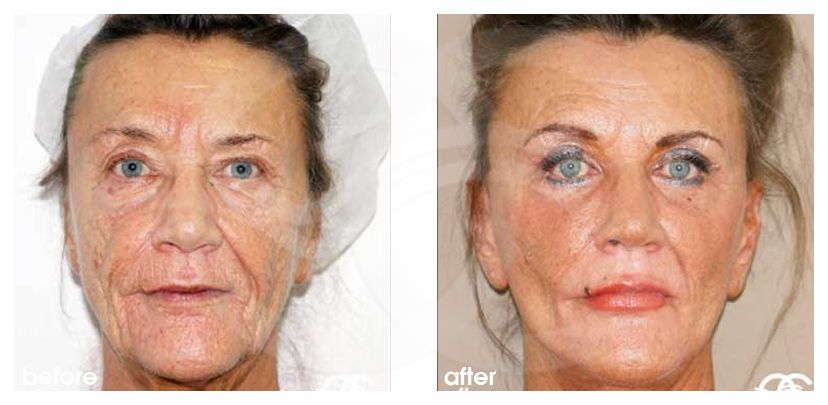 Lifting du Visage 10 ante/post-op profil