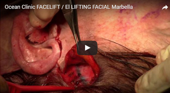 Gesichtsstraffung Operation mit neuerster Technologie Video. Ocean Clinic Marbella
