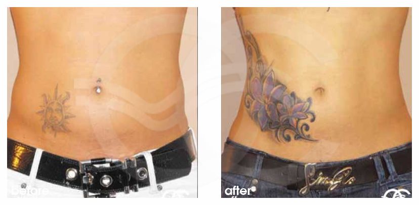 Lipo before and after real clinical case 02