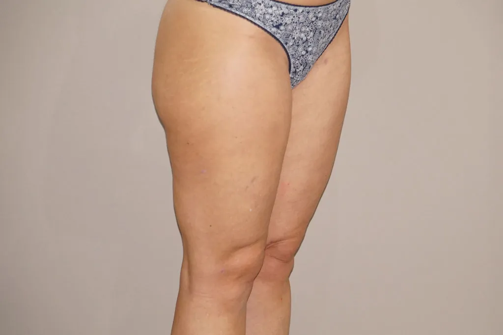 Resultado después de Liposucción – vista lateral