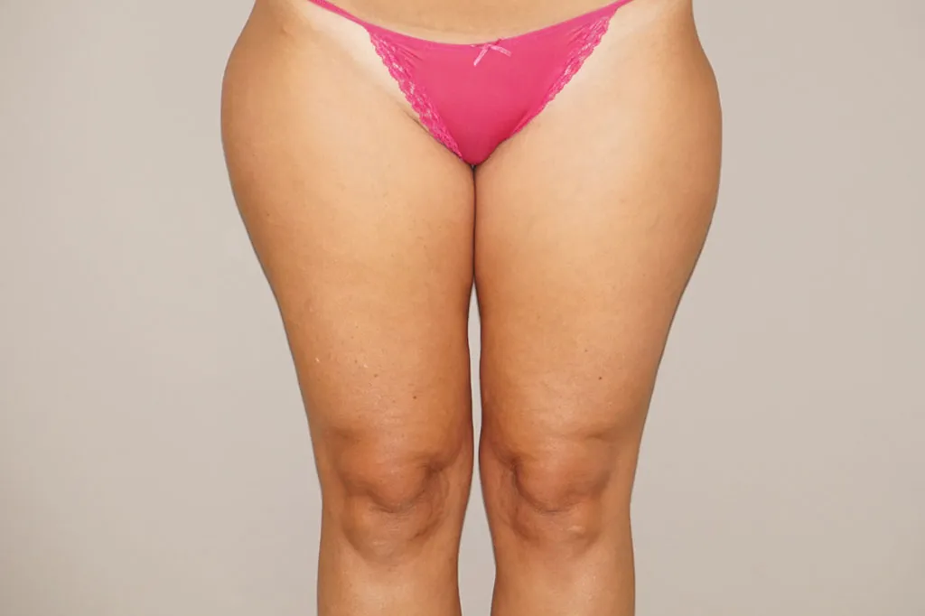 Liposucción en Marbella antes de la cirugía – vista frontal