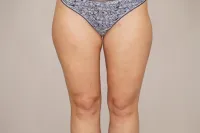 Caso real Liposucción Marbella - 01