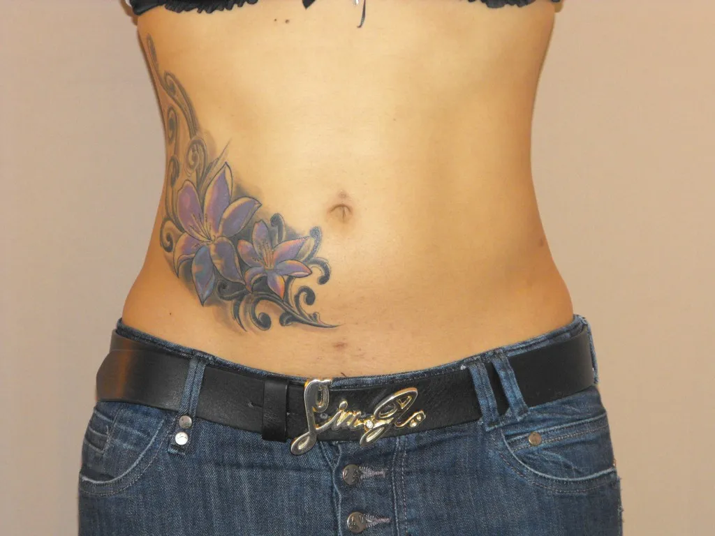 Resultado después de Liposucción – vista frontal