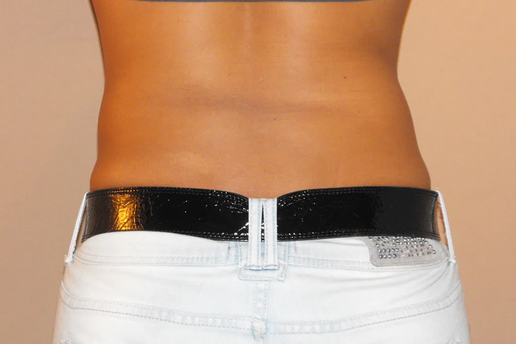 Liposucción antes de la cirugía – vista 3/4