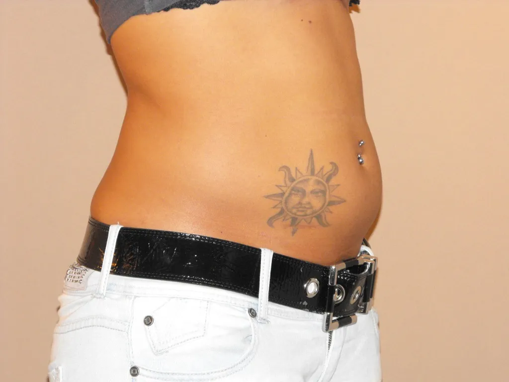 Liposucción antes de la cirugía – vista lateral