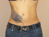 Caso real Liposucción Marbella - 02