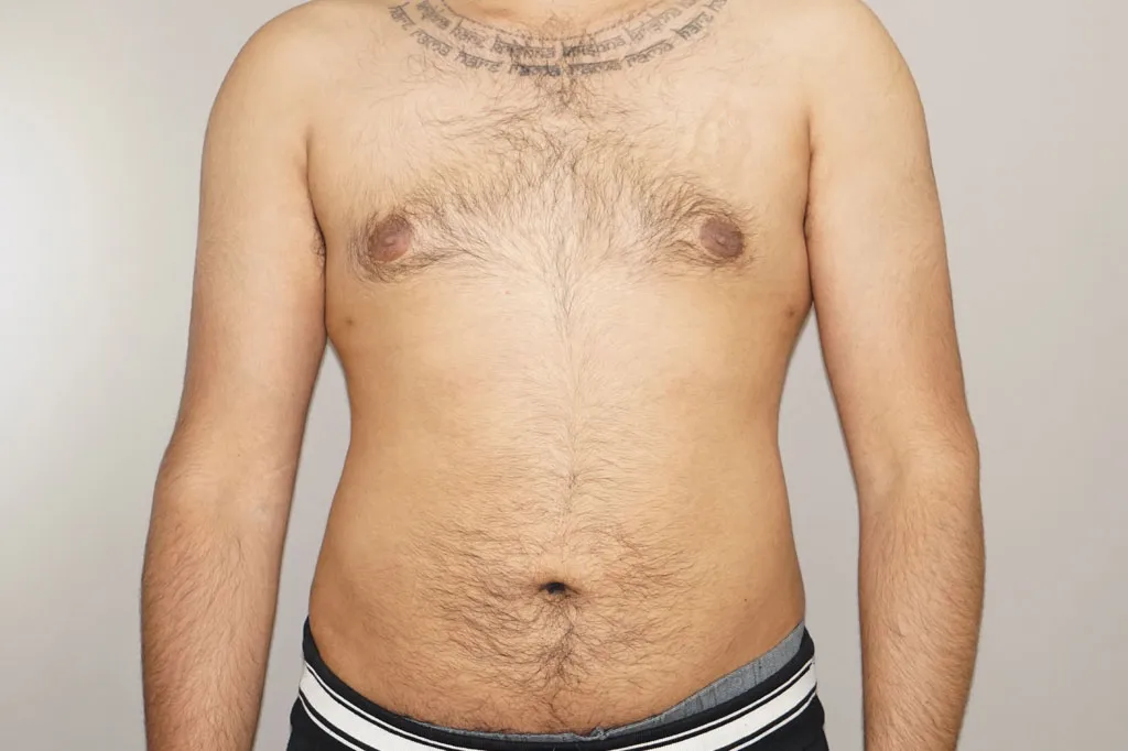 Resultado después de Liposucción – vista frontal