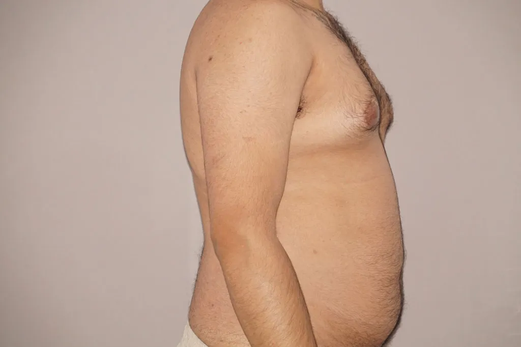 Liposucción antes de la cirugía – vista lateral